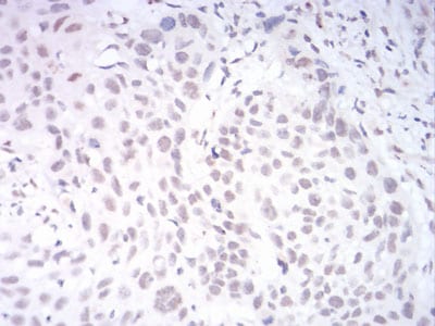 Figure 6:Immunohistochemical analysis of paraffin-embedded esophageal cancer tissues using AOF1 mouse mAb with DAB staining.