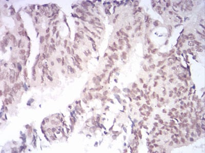 Figure 7:Immunohistochemical analysis of paraffin-embedded rectum cancer tissues using AOF1 mouse mAb with DAB staining.