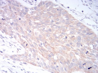 Figure 5:Immunohistochemical analysis of paraffin-embedded esophageal cancer tissues using LRP1 mouse mAb with DAB staining.