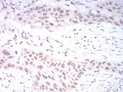 Figure 6:Immunohistochemical analysis of paraffin-embedded esophageal cancer tissues using DNMT3B mouse mAb with DAB staining.