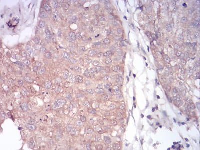 Figure 8:Immunohistochemical analysis of paraffin-embedded bladder cancer tissues using PLCG1 mouse mAb with DAB staining.