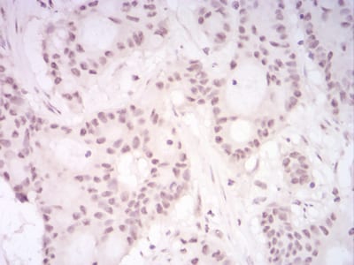 Figure 7:Immunohistochemical analysis of paraffin-embedded HeLa tissues using DDX39B mouse mAb with DAB staining.