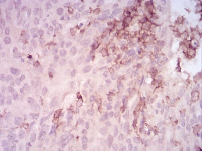 Figure 5:Immunohistochemical analysis of paraffin-embedded ovarian cancer tissues using MMP14 mouse mAb with DAB staining.