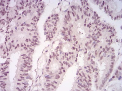 Figure 6:Immunohistochemical analysis of paraffin-embedded rectum cancer tissues using LRP1 mouse mAb with DAB staining.