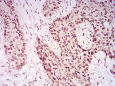 Figure 7:Immunohistochemical analysis of paraffin-embedded cervical cancer tissues using CBX2 mouse mAb with DAB staining.