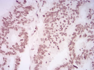 Figure 5:Immunohistochemical analysis of paraffin-embedded rectum cancer tissues using HIST2H4A(20Me) mouse mAb with DAB staining.