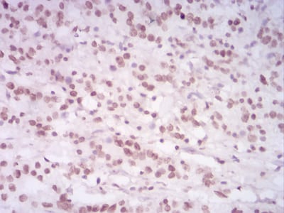 Figure 6:Immunohistochemical analysis of paraffin-embedded stomach cancer tissues using HIST2H4A(20Me) mouse mAb with DAB staining.