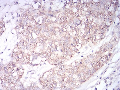 Figure 3:Immunohistochemical analysis of paraffin-embedded bladder cancer tissues using SK2 mouse mAb with DAB staining.