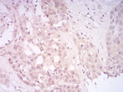 Figure 4:Immunohistochemical analysis of paraffin-embedded liver cancer tissues using SIRT7 mouse mAb with DAB staining.