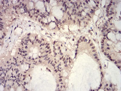 Figure 4:Immunohistochemical analysis of paraffin-embedded colon cancer tissues using HIST2H3C(27Ac) mouse mAb with DAB staining.