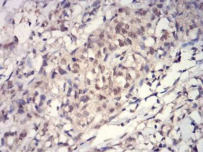 Figure 5:Immunohistochemical analysis of paraffin-embedded breast cancer tissues using HIST2H3C(27Ac) mouse mAb with DAB staining.