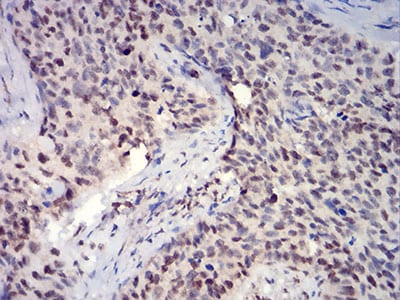 Figure 4:Immunohistochemical analysis of paraffin-embedded cervical cancer tissues using HIST2H3C(27Ac) mouse mAb with DAB staining.