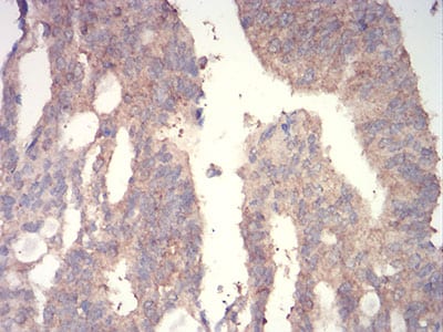 Figure 7:Immunohistochemical analysis of paraffin-embedded rectum cancer tissues using WNT3A mouse mAb with DAB staining.