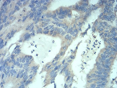 Figure 8:Immunohistochemical analysis of paraffin-embedded rectum cancer tissues using MECP2 mouse mAb with DAB staining.