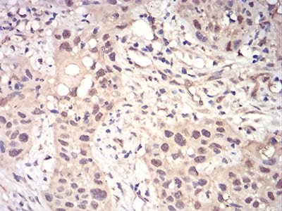 Figure 6:Immunohistochemical analysis of paraffin-embedded esophageal cancer tissues using RAD23A mouse mAb with DAB staining.