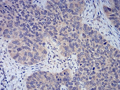 Figure 6:Immunohistochemical analysis of paraffin-embedded cervical cancer tissues using FOXP3 mouse mAb with DAB staining.