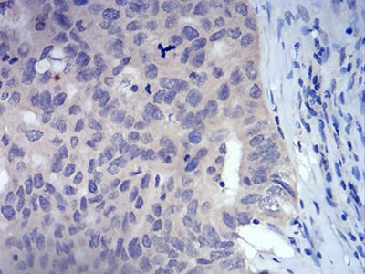 Figure 7:Immunohistochemical analysis of paraffin-embedded ovarian cancer tissues using FOXP3 mouse mAb with DAB staining.