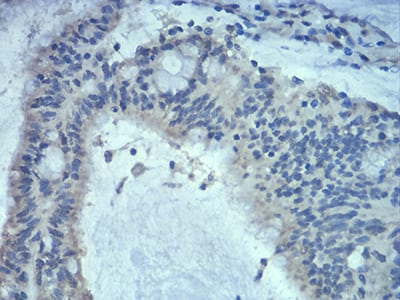 Figure 7:Immunohistochemical analysis of paraffin-embedded colon cancer tissues using Rab5a mouse mAb with DAB staining.
