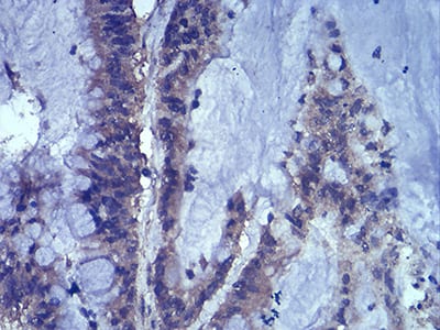 Figure 5:Immunohistochemical analysis of paraffin-embedded colon cancer tissues using LEF1 mouse mAb with DAB staining.