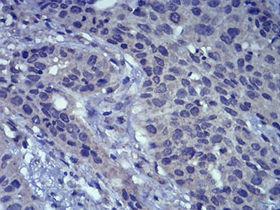 Figure 6:Immunohistochemical analysis of paraffin-embedded esophageal cancer tissues using LEF1 mouse mAb with DAB staining.