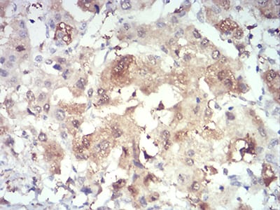 Figure 5:Immunohistochemical analysis of paraffin-embedded liver cancer tissues using PRDM4 mouse mAb with DAB staining.