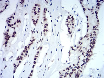Figure 7:Immunohistochemical analysis of paraffin-embedded colon cancer tissues using CBX5 mouse mAb with DAB staining.