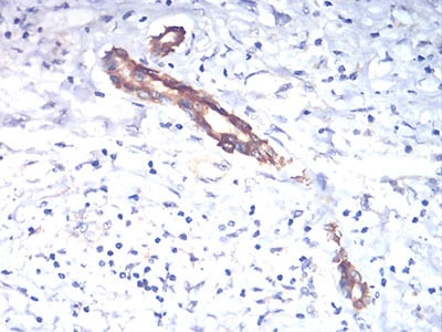 Figure 4:Immunohistochemical analysis of paraffin-embedded liver cancer tissues using TSHB mouse mAb with DAB staining.