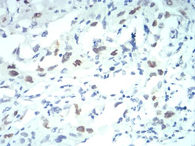 Figure 7:Immunohistochemical analysis of paraffin-embedded lung cancer tissues using KPNA2 mouse mAb with DAB staining.