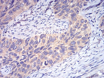 Figure 9:Immunohistochemical analysis of paraffin-embedded cervical cancer tissues using DDX3X mouse mAb with DAB staining.