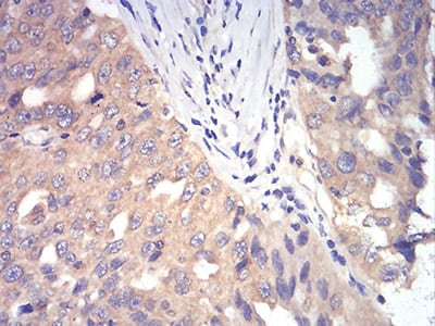 Figure 10:Immunohistochemical analysis of paraffin-embedded ovarian cancer tissues using DDX3X mouse mAb with DAB staining.
