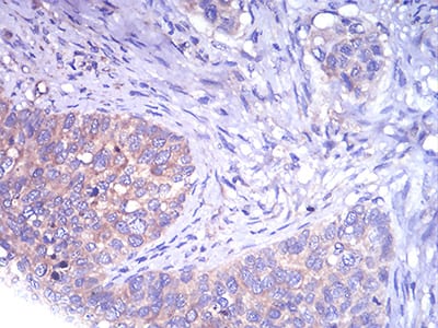 Figure 8:Immunohistochemical analysis of paraffin-embedded cervical cancer tissues using TH mouse mAb with DAB staining.