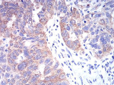 Figure 5:Immunohistochemical analysis of paraffin-embedded ovarian cancer tissues using TBCC mouse mAb with DAB staining.