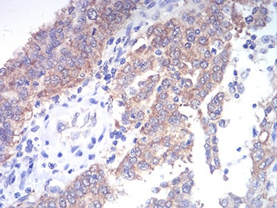 Figure 6:Immunohistochemical analysis of paraffin-embedded endometrial cancer tissues using TBCC mouse mAb with DAB staining.