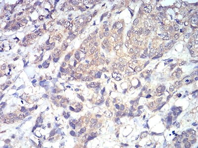 Figure 7:Immunohistochemical analysis of paraffin-embedded breast cancer tissues using PLCG1 mouse mAb with DAB staining.