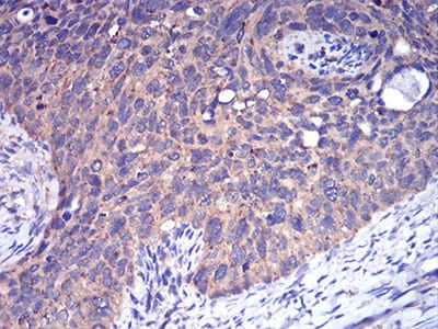 Figure 6:Immunohistochemical analysis of paraffin-embedded cervical cancer tissues using CFHR5 mouse mAb with DAB staining.