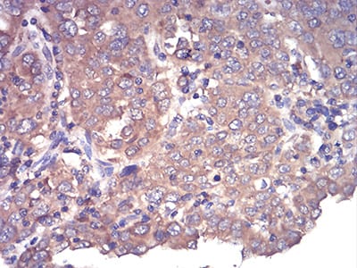 Figure 7:Immunohistochemical analysis of paraffin-embedded endometrial cancer tissues using CFHR5 mouse mAb with DAB staining.