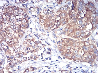 Figure 5:Immunohistochemical analysis of paraffin-embedded bladder cancer tissues using Rab1b mouse mAb with DAB staining.
