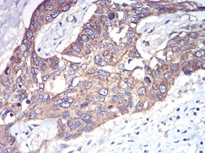 Figure 6:Immunohistochemical analysis of paraffin-embedded esophageal cancer tissues using Rab1b mouse mAb with DAB staining.