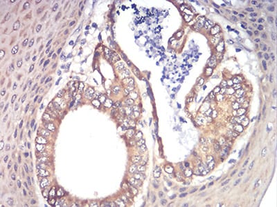 Figure 8:Immunohistochemical analysis of paraffin-embedded esophageal cancer tissues using RAD21 mouse mAb with DAB staining.