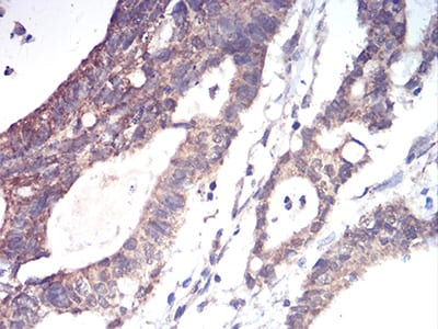 Figure 8:Immunohistochemical analysis of paraffin-embedded rectum cancer tissues using ALDH6A1 mouse mAb with DAB staining.