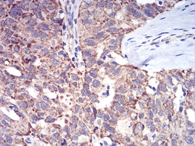 Figure 7:Immunohistochemical analysis of paraffin-embedded ovarian cancer tissues using ALDH6A1 mouse mAb with DAB staining.