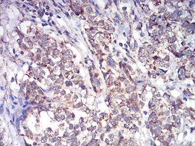 Figure 8:Immunohistochemical analysis of paraffin-embedded bladder cancer tissues using ALDH6A1 mouse mAb with DAB staining.