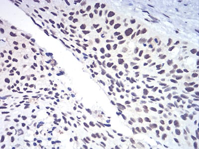 Figure 6:Immunohistochemical analysis of paraffin-embedded esophageal cancer tissues using RAD50 mouse mAb with DAB staining.