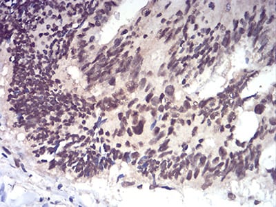 Figure 7:Immunohistochemical analysis of paraffin-embedded rectum cancer tissues using RAD50 mouse mAb with DAB staining.