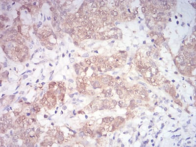 Figure 8:Immunohistochemical analysis of paraffin-embedded bladder cancer tissues using MAP2K3 mouse mAb with DAB staining.