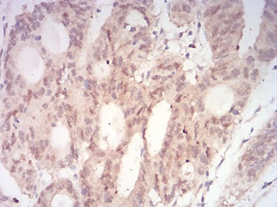 Figure 9:Immunohistochemical analysis of paraffin-embedded rectum cancer tissues using MAP2K3 mouse mAb with DAB staining.
