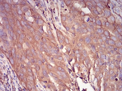 Figure 7:Immunohistochemical analysis of paraffin-embedded ovarian cancer tissues using SERPINA1 mouse mAb with DAB staining.