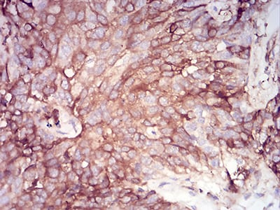 Figure 8:Immunohistochemical analysis of paraffin-embedded bladder cancer tissues using SERPINA1 mouse mAb with DAB staining.