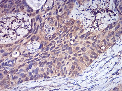 Figure 7:Immunohistochemical analysis of paraffin-embedded cervical cancer tissues using CFHR5 mouse mAb with DAB staining.