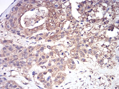 Figure 8:Immunohistochemical analysis of paraffin-embedded ovarian cancer tissues using CFHR5 mouse mAb with DAB staining.